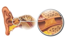 Çocuklarda Kulak Kiri Belirtileri ve Tedavisi