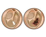 Kulak Zarı Delinmesi Belirtileri ve Tedavisi